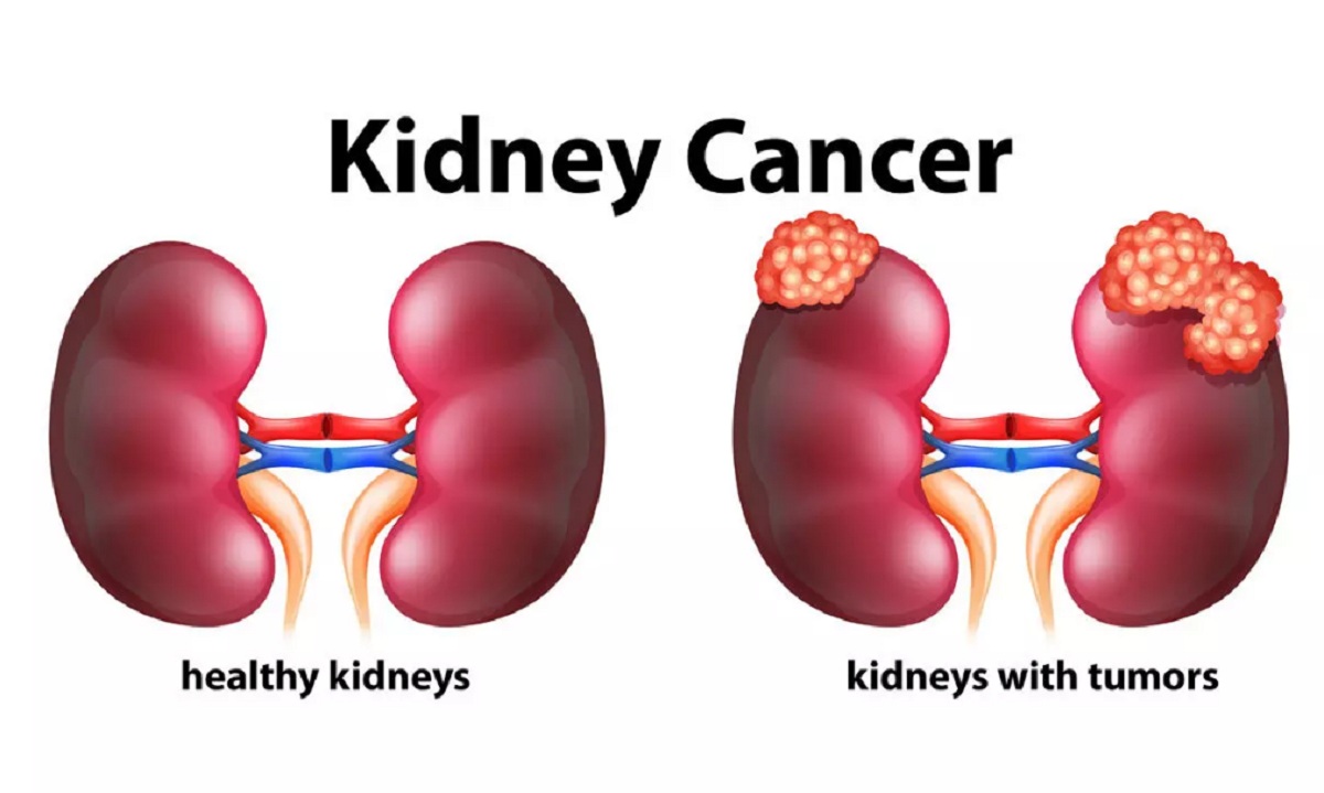 What is RCC in the kidney?