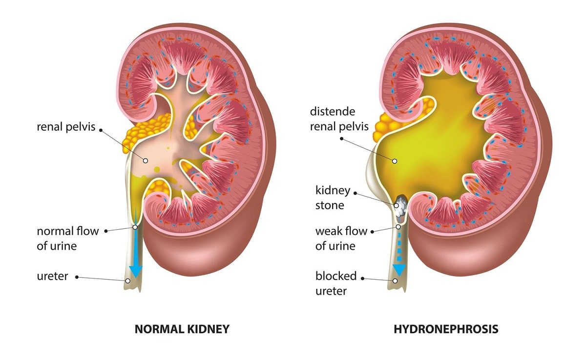 What is UPJO in kidney?