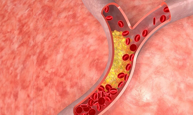 انواع بیماری های خاموش: کلسترول بالا 