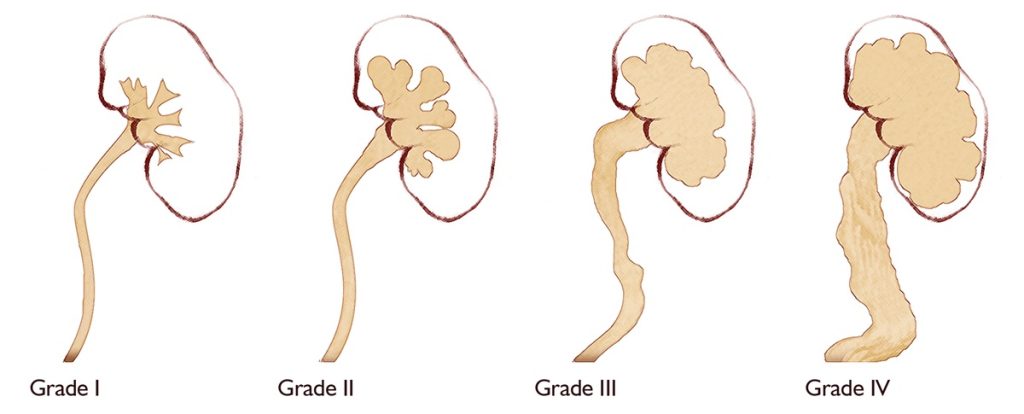 What does fullness mean in kidney ultrasound? (hydronephrosis or kidney filling)