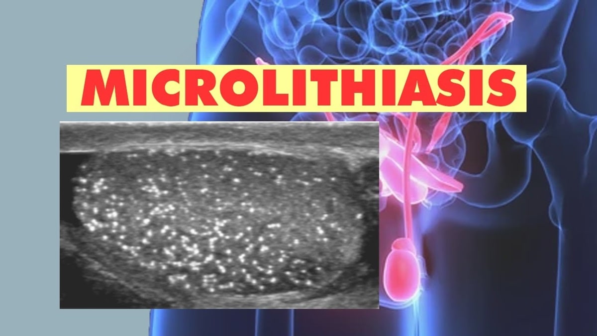 What is microlithiasis in the kidney? Recognition of small kidney stones