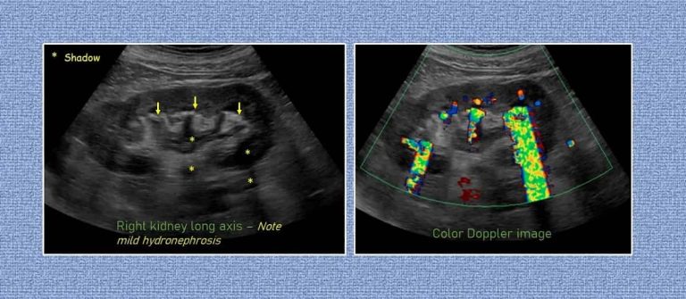 سنگ کلیه با سونوگرافی تشخیص داده می‌شود؟